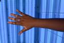 HDS - Referência vitiligo