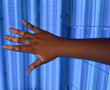 HDS - Referência vitiligo