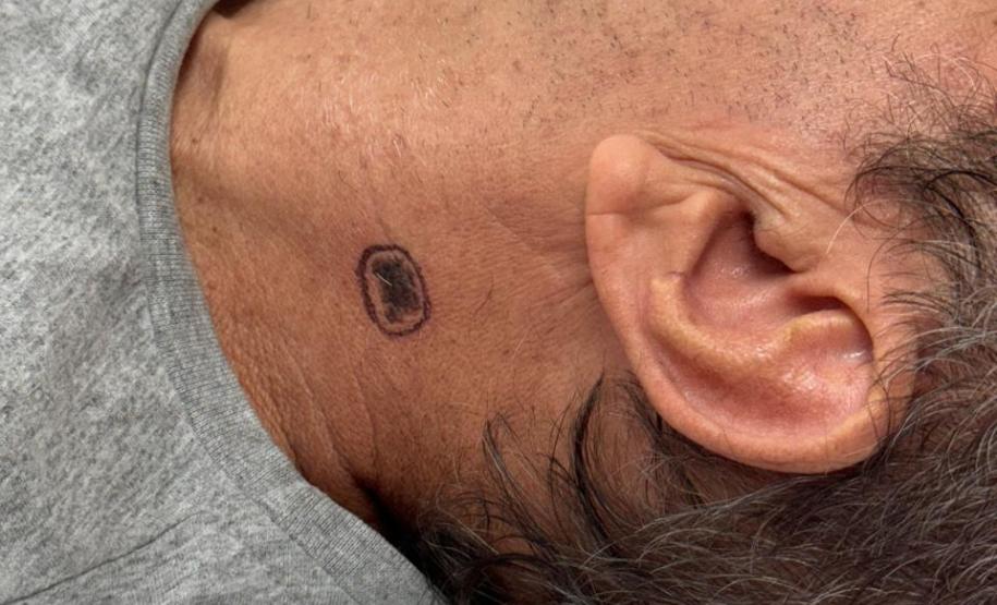 HDS - Mutirão de consultas dermatológicas no HRL