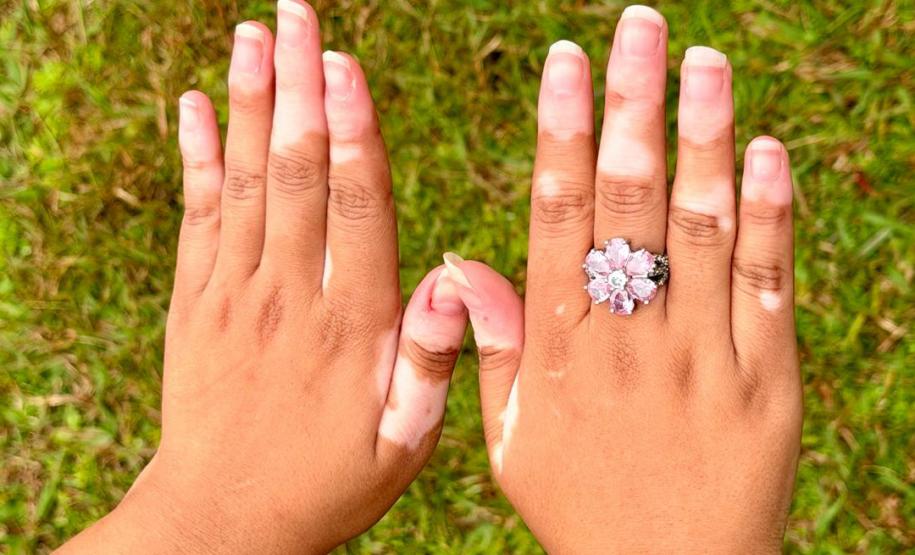 HDS - Referência vitiligo